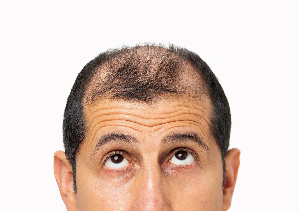 Man with hair thinning
