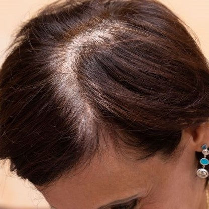 photo of woman with parted hair revealing hair thinning and hair loss